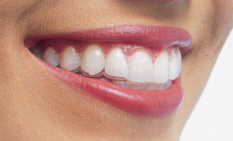 Ortodontia com aparelho fixo ou alinhador invisível: Custos